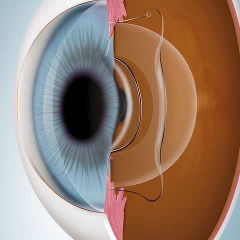 Cut away drawing of the front of the eye, with a thin lens placed just behind the coloured iris