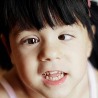 A young girl whose two eyes point in different directions