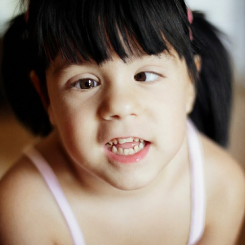 Strabismus Strabismus